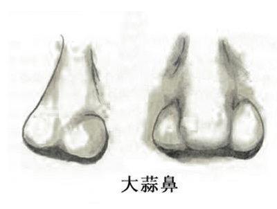蒜头鼻的女人命运怎样 蒜头鼻的女人值得娶吗