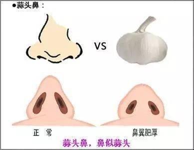 蒜头鼻虽丑但面相好，蒜头鼻面相特征