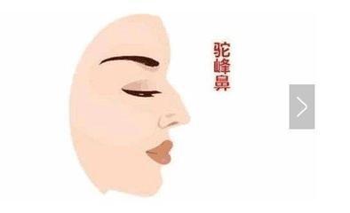 详解驼峰鼻的面相好不好 长有驼峰鼻说明什么