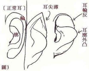 这些恶痣让你运气变得很差 一定不能留