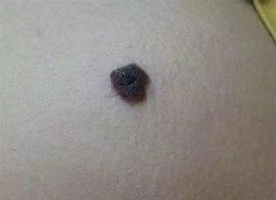 身上长红痣的人命好不好 身上长红痣说明什么