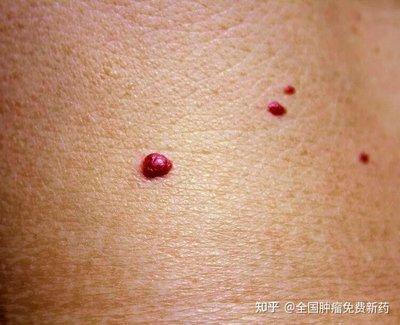 身体长红痣是什么意思 身上长红痣的人命运好不好