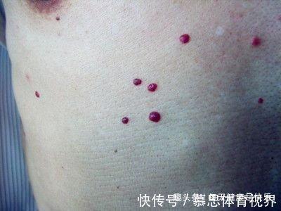 身体长红痣是什么意思 身上长红痣的人命运好不好