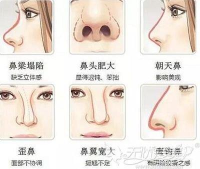 面相学鼻梁歪的人有何特点 歪鼻梁的人命运如何