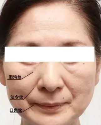 面相泪沟纹看相，有泪沟纹面相命运如何