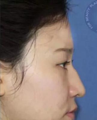 驼峰鼻子面相好不好 驼峰鼻意味着什么