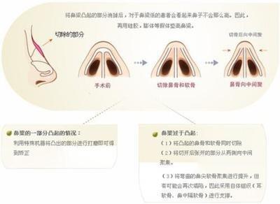 驼峰鼻的面相特征怎么样 长有驼峰鼻的人命运如何