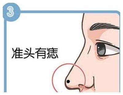 鼻头有痣财运好 鼻子长痣是什么意思