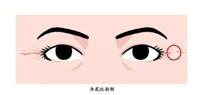 鱼尾纹面相含义 长鱼尾纹说明了什么