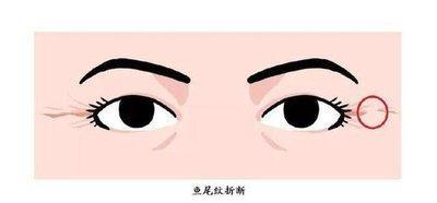 鱼尾纹面相图解分几种 透过鱼尾纹面相看运势 鱼尾纹面相图解分几种 透过鱼尾纹面相看运势