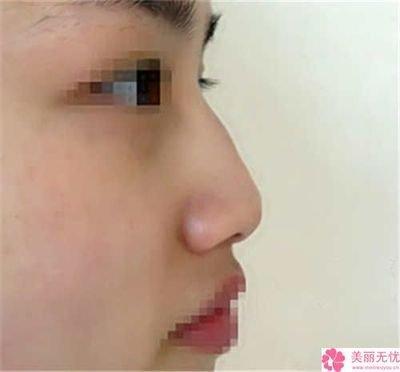 鼻子朝天的人运气好不好 鼻孔朝天面相意味着什么