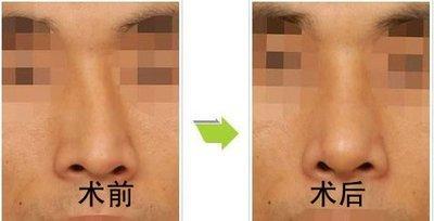 鼻子歪了是什么预兆 鼻子歪的人命运怎样