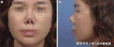 鼻孔外露的女人命运一定不好 女人鼻孔外露怎样