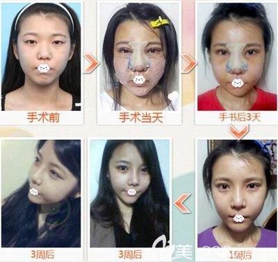 鼻梁塌陷的人真的穷一辈子吗 鼻梁塌陷的人命运好不好