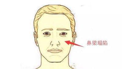 鼻梁歪的男人面相分析 鼻梁歪的男人命运如何 鼻梁歪的男人面相分析 鼻梁歪的男人命运如何