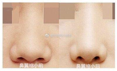 鼻翼肥大的人运气怎么样 鼻翼肥大到底好不好