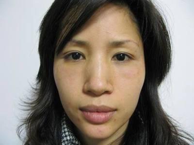 鼻翼肥大面相分析 鼻翼肥大说明了什么