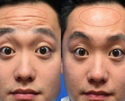 抬头纹深是怎么回事 抬头纹深说明了什么