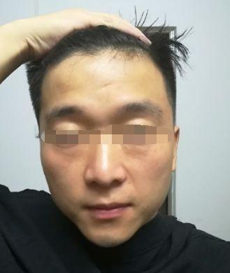 抬头纹过多命运坎坷 抬头纹多有哪些影响