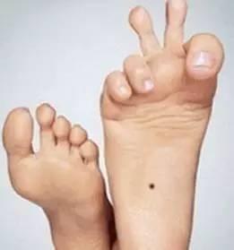 脚底长痣是什么意思 会带来哪些影响